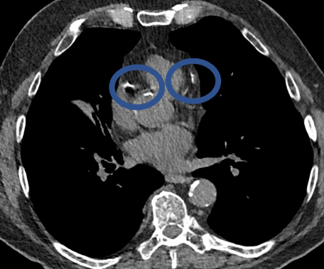 coronary calcium of the heart