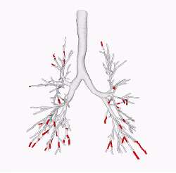 mucus plugs on ct scan