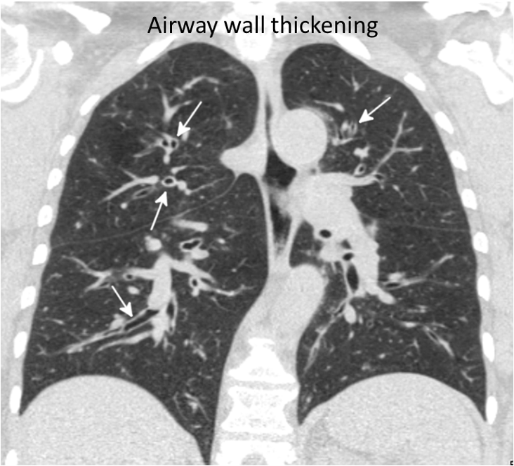 airway wall thickening