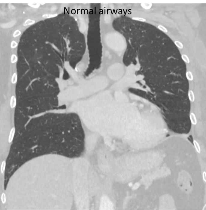 coronal view normal airways in non-smoker