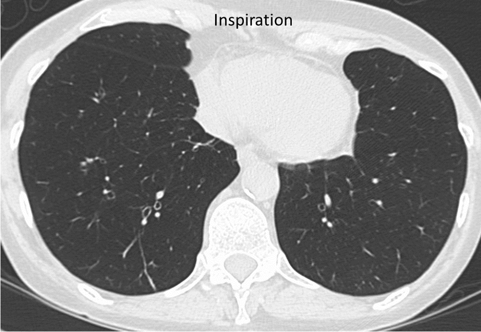 obstructive bronchiolitis inspiratory scan