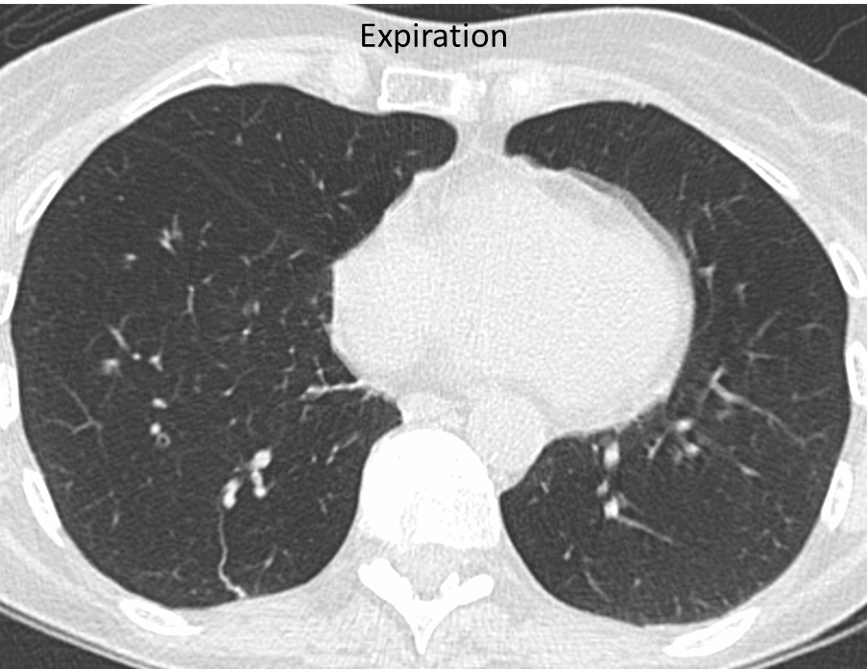 obstructive bronchiolitis visible on expiratory scan