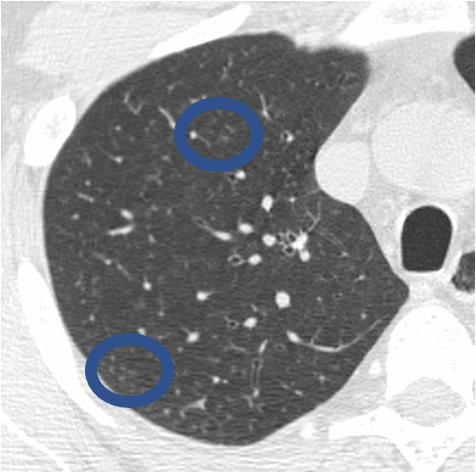 inflammatory bronchiolitis