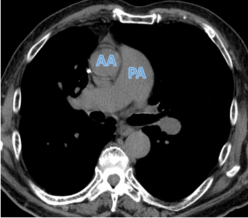 pulmonary artery larger than adjacent ascending aorta